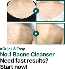 SomeByMi | AHA BHA PHA 30 Days Miracle Acne Clear Body Cleanser 400g